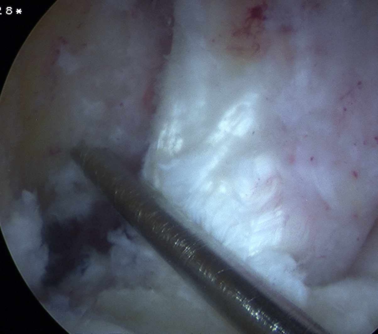 ACL Anteromedial Beath Pin
